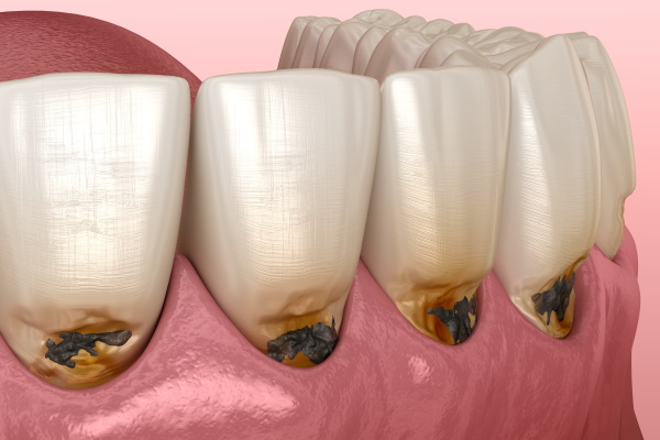 Cervical caries on frontal teeth. Medically accurate tooth 3D illustration.