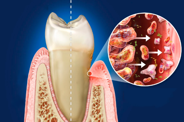 healthy-gum-tissue-vs-diseased