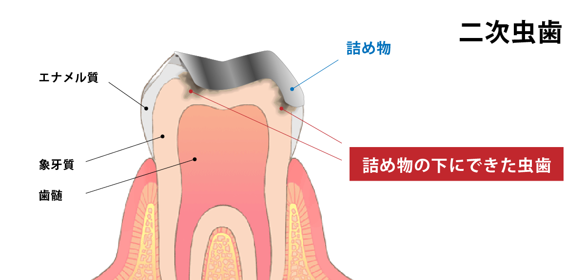 成人からの虫歯に要注意 東京都新宿区で歯科予防メインテナンス 予防よくわかるサイト